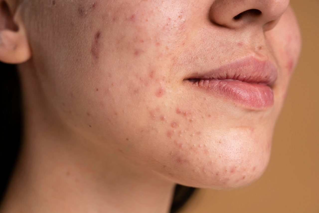 acne pelle acne pelle