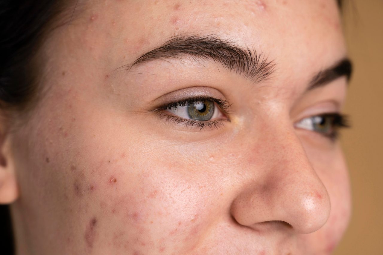acne acne